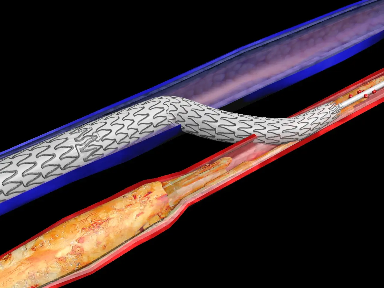 LimFlow crossing stent