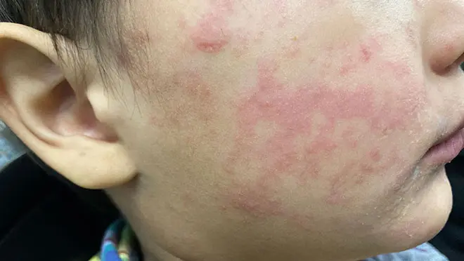 measles-rash-660x3721-1