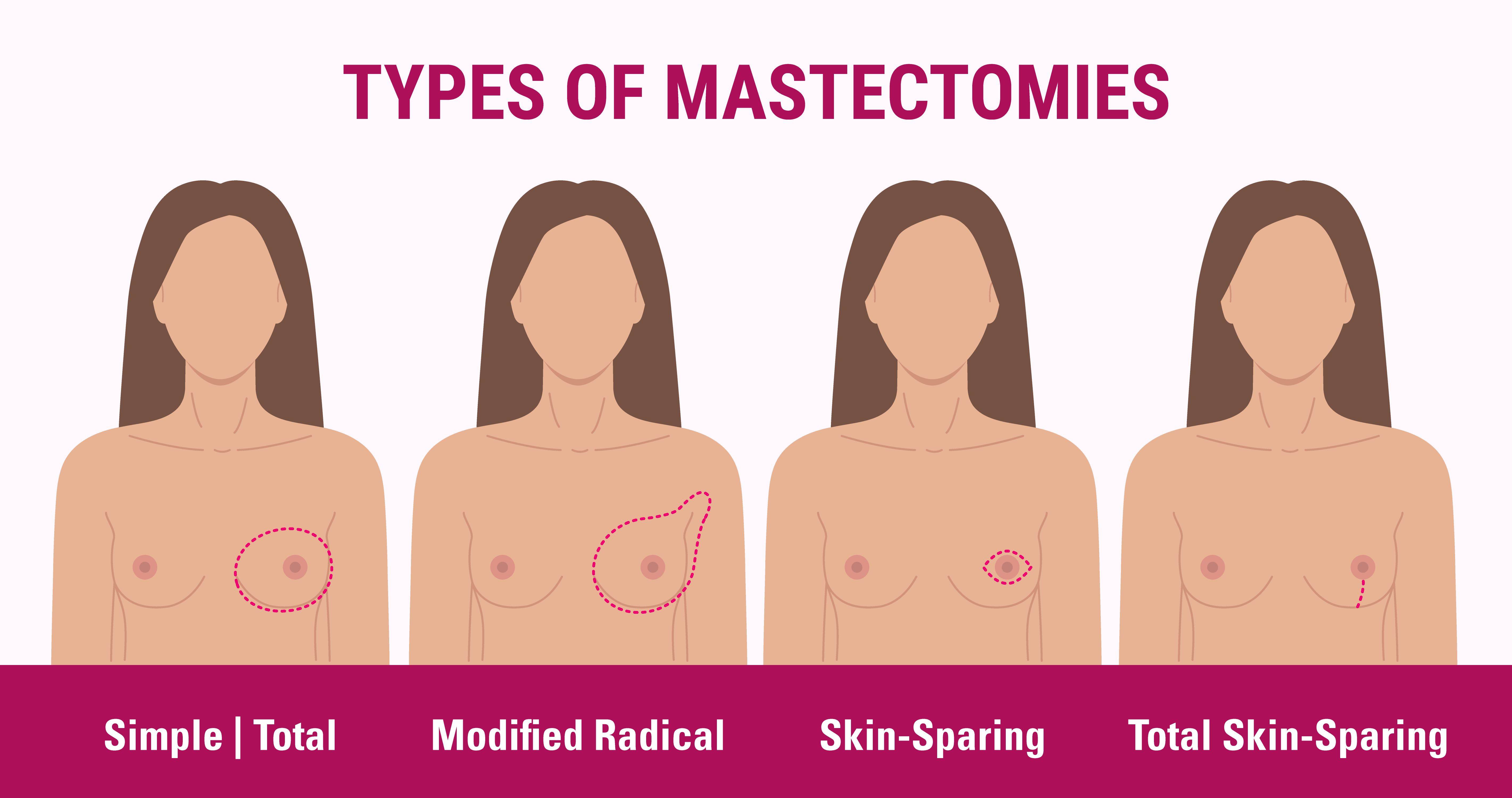 Types of Mastectomies