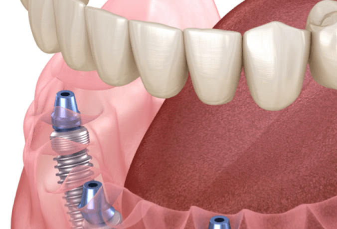 All on four dental implants