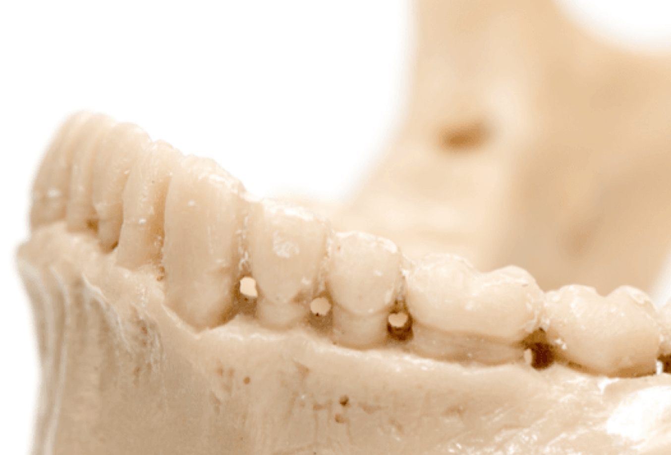 Dental impressions of bottom jaw