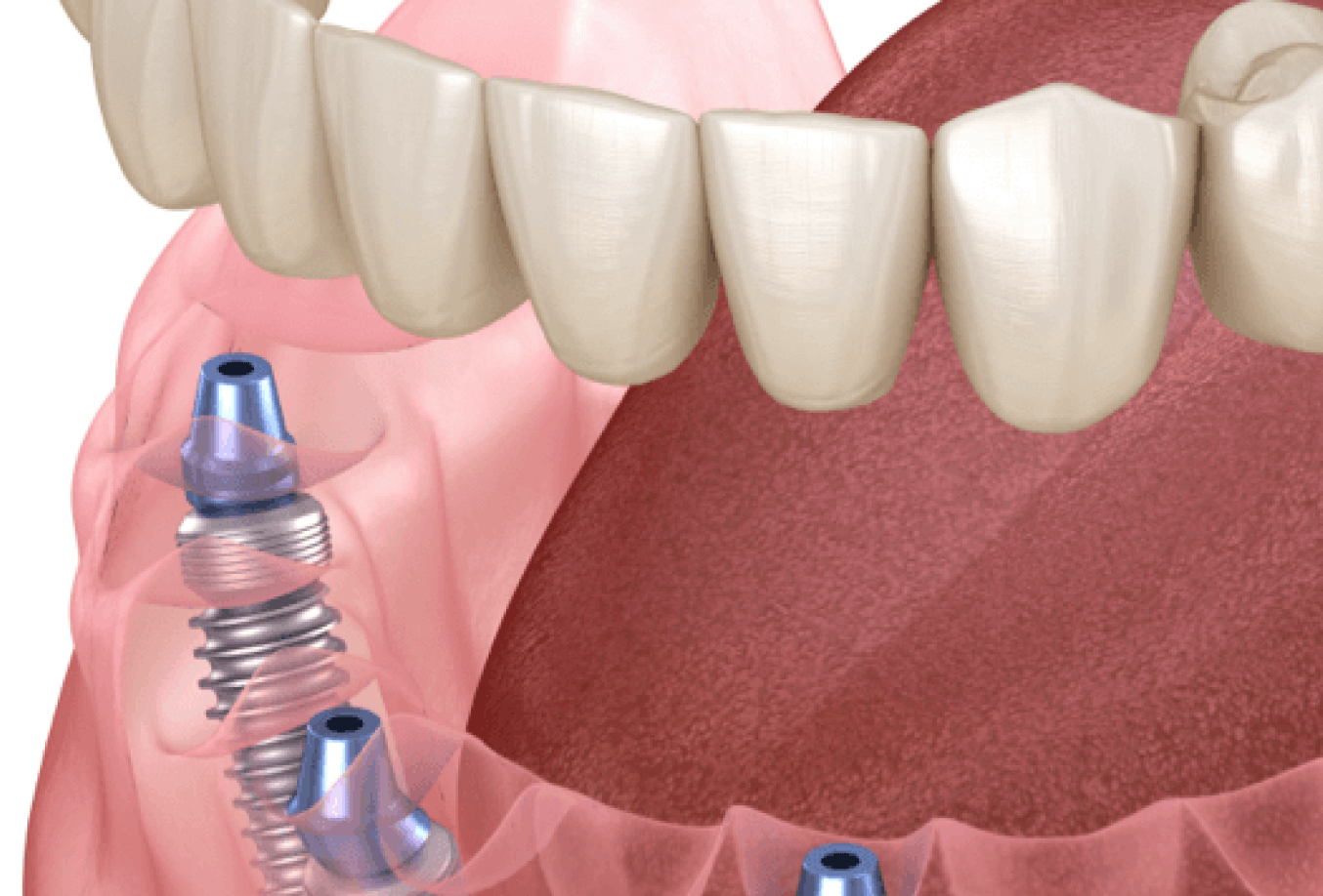 Graphic of dental implants