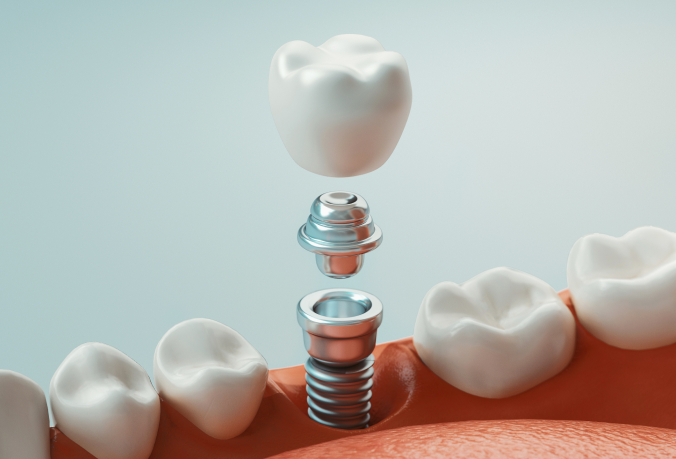 Single dental implant