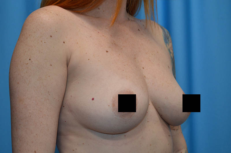 Breast augmentation before photo 10