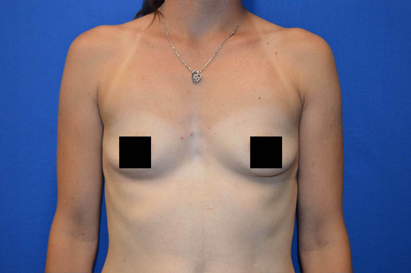 Breast augmentation before photo 11