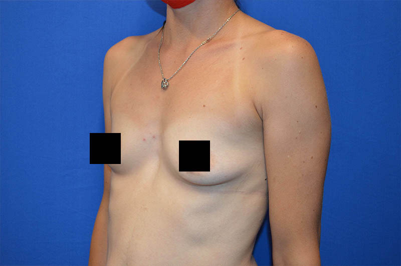 Breast augmentation before photo 12