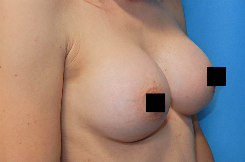 Breast augmentation after photo 12