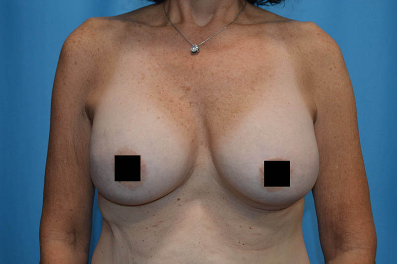 Breast augmentation after photo 1