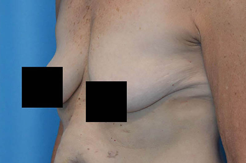 Breast augmentation before photo 2