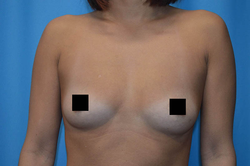 Breast augmentation before photo 3