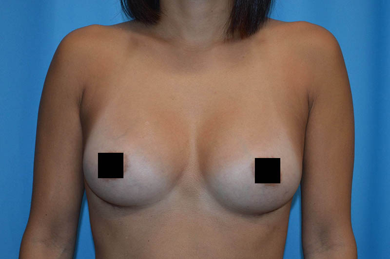 Breast augmentation after photo 3