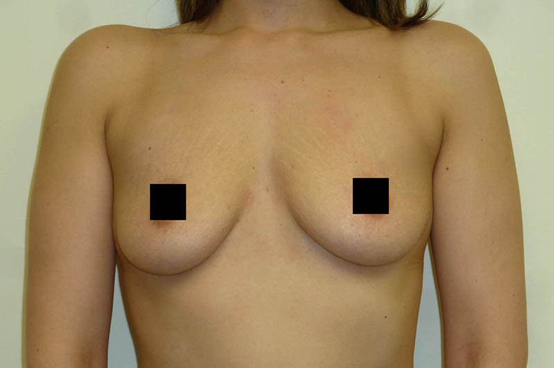 Breast augmentation before photo 5