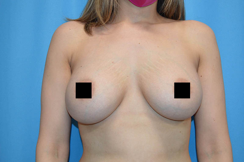 Breast augmentation after photo 5