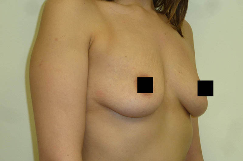 Breast augmentation before photo 6