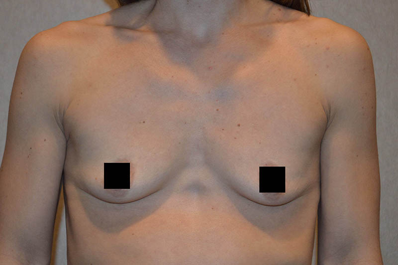 Breast augmentation before photo 7