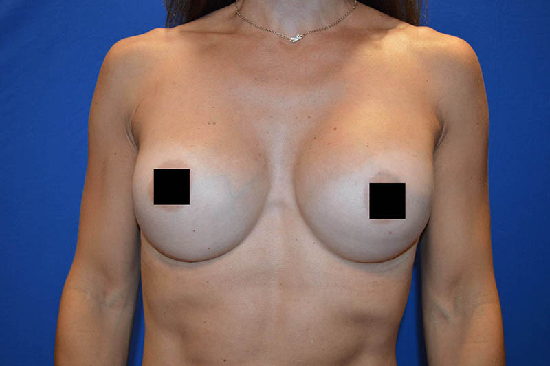 Breast augmentation after photo 7