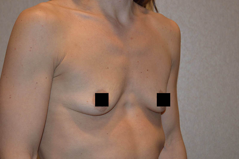 Breast augmentation before photo 8