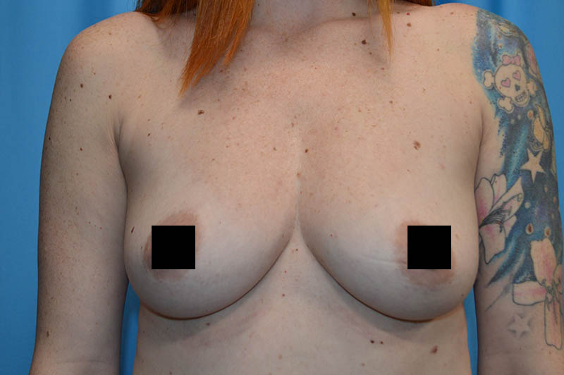 Breast augmentation before photo 9