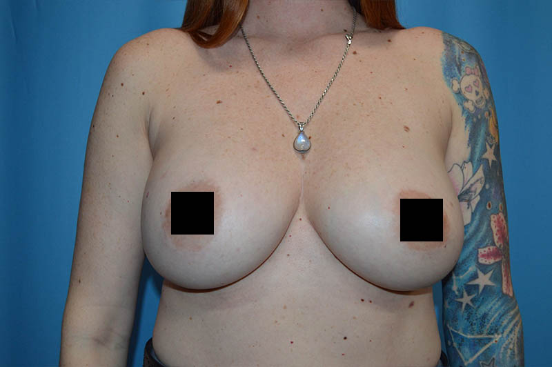 Breast augmentation after photo 9