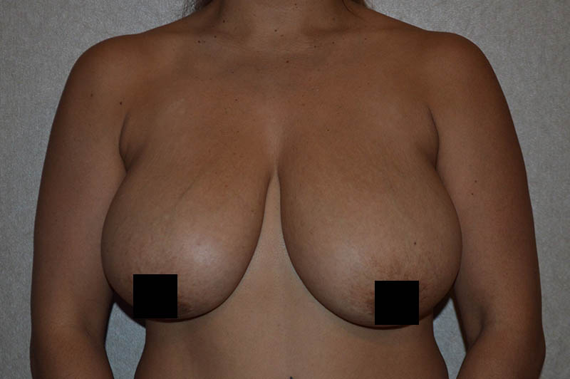 Breast reduction before photo 3