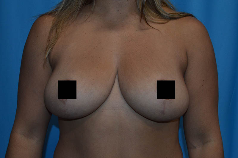 Breast reduction after photo 3