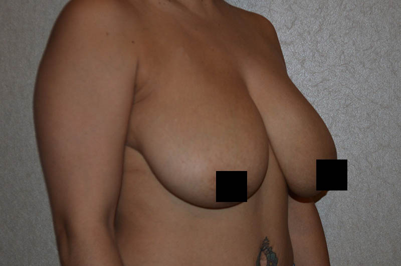 Breast reduction before photo 4