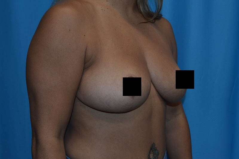 Breast reduction after photo 4
