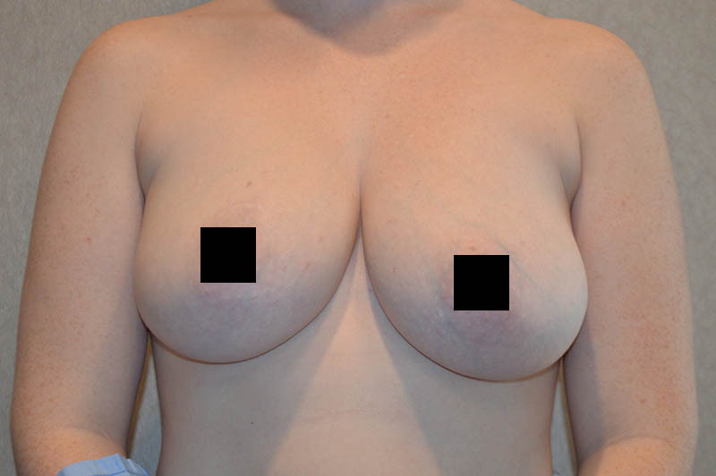Breast reduction before photo 5