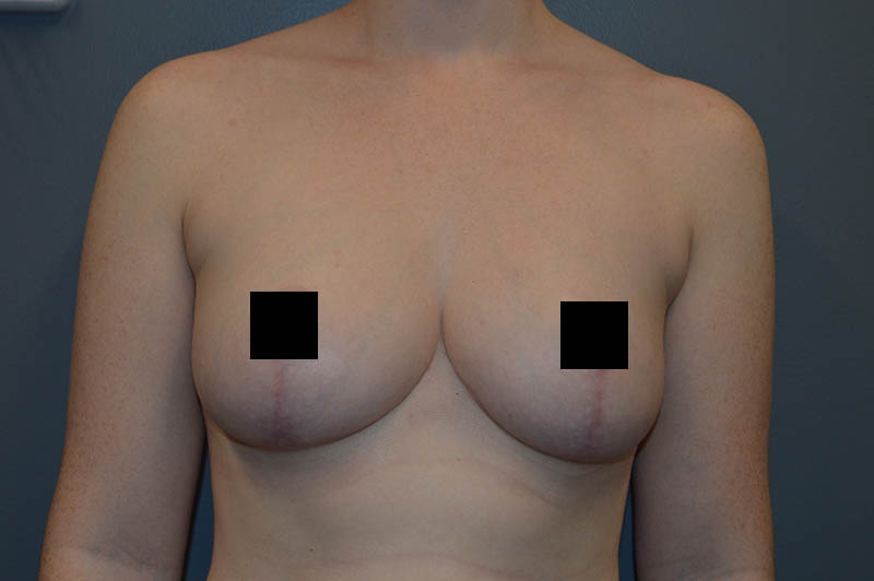 Breast reduction after photo 5