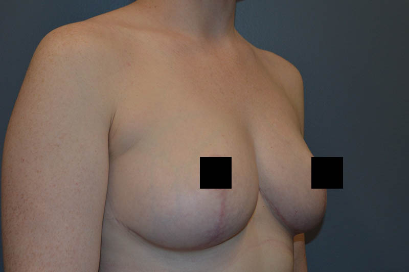 Breast reduction after photo 6