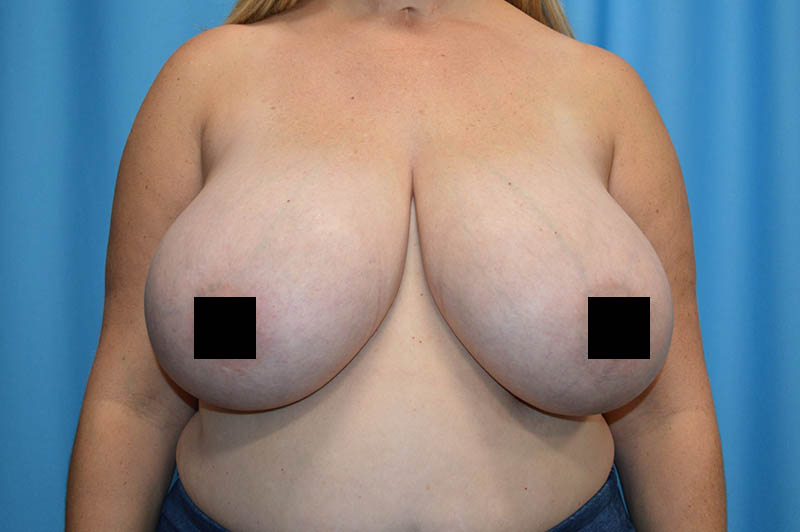 Breast reduction before photo 7