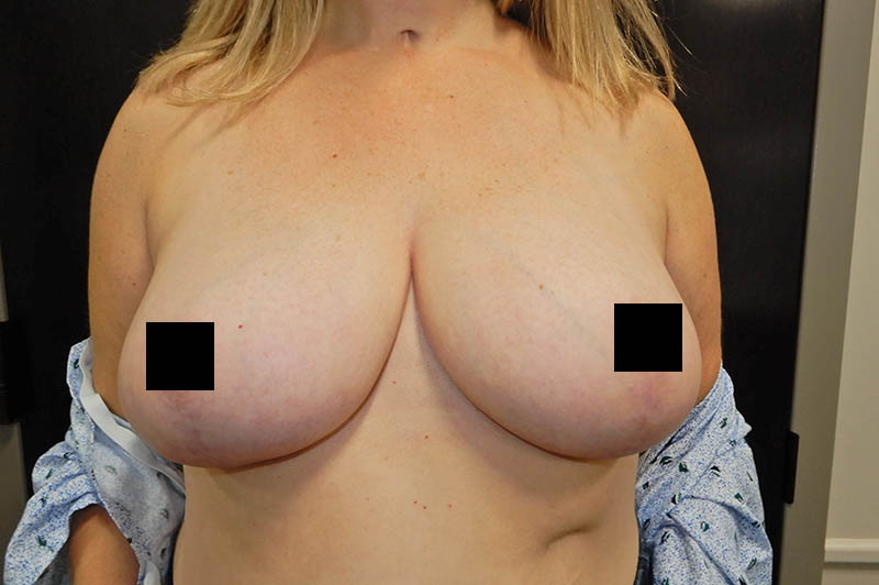 Breast reduction after photo 7