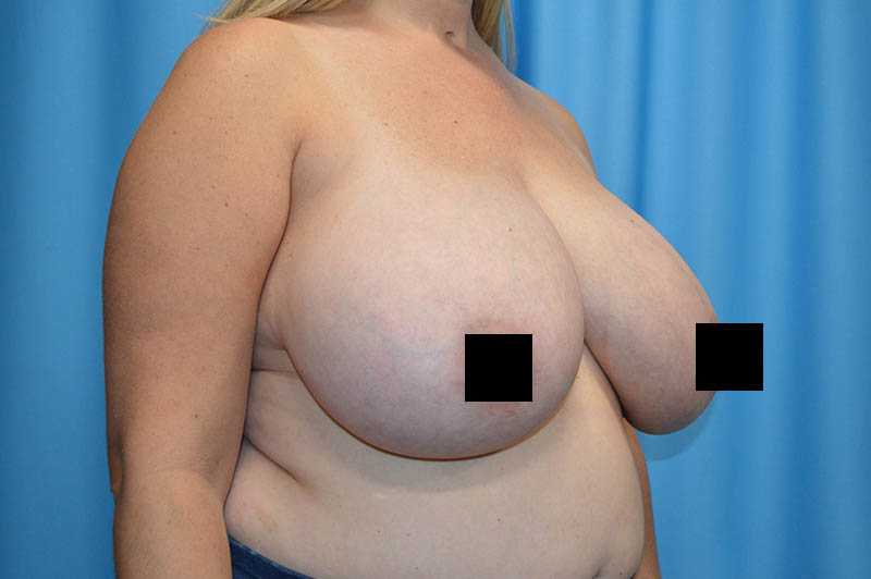 Breast reduction before photo 8