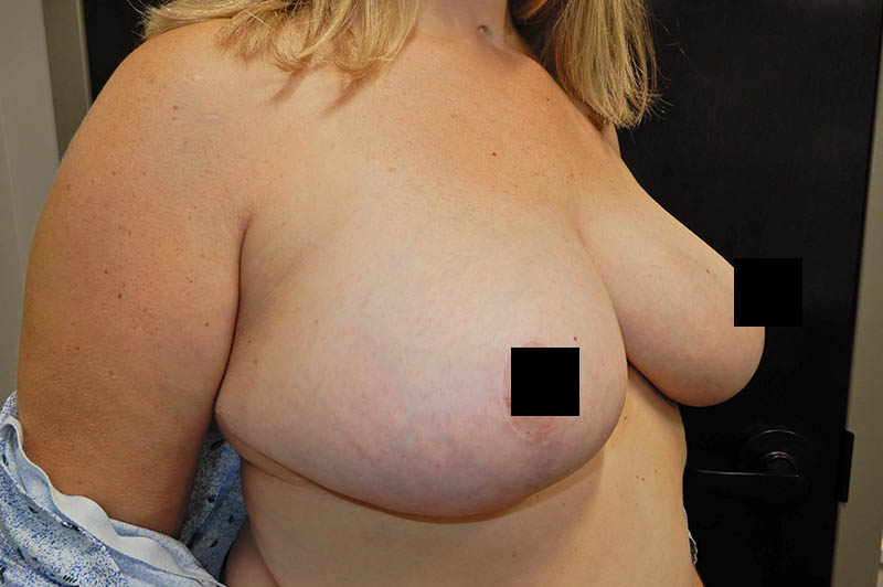 Breast reduction after photo 8